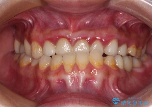 むし歯だらけの奥歯　セラミッククラウンによるむし歯治療の治療後