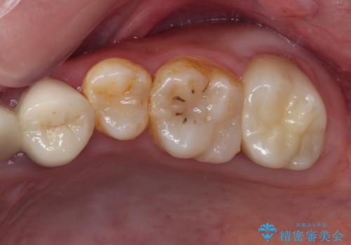 むし歯だらけの奥歯　セラミッククラウンによるむし歯治療の症例 治療後