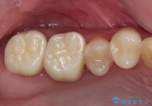むし歯だらけの奥歯　セラミッククラウンによるむし歯治療の治療後