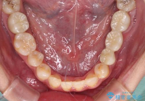 むし歯だらけの奥歯　セラミッククラウンによるむし歯治療の治療後