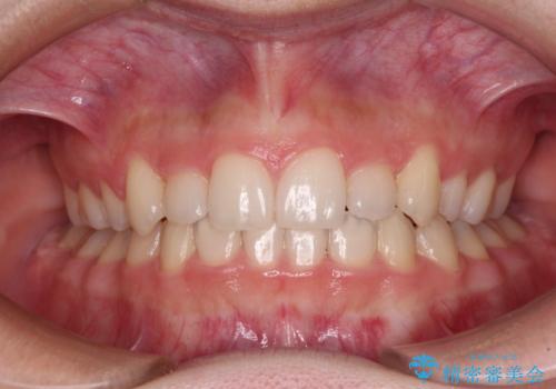 目立つ八重歯を目立たない装置で　ハーフリンガルによる抜歯矯正の症例 治療後