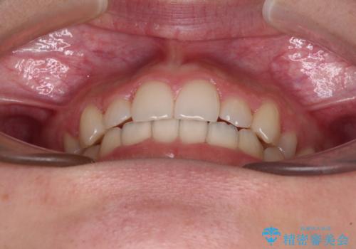 目立つ八重歯を目立たない装置で ハーフリンガルによる抜歯矯正の治療後