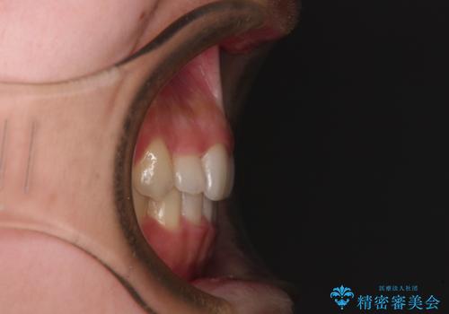 目立つ八重歯を目立たない装置で ハーフリンガルによる抜歯矯正の治療後