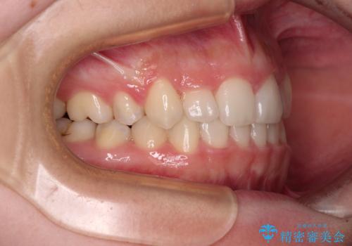 目立つ八重歯を目立たない装置で ハーフリンガルによる抜歯矯正の治療後
