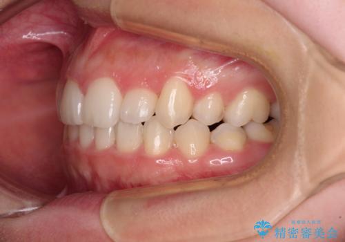 目立つ八重歯を目立たない装置で　ハーフリンガルによる抜歯矯正の治療後