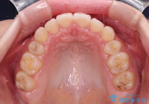 目立つ八重歯を目立たない装置で ハーフリンガルによる抜歯矯正の治療後
