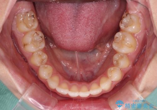 目立つ八重歯を目立たない装置で ハーフリンガルによる抜歯矯正の治療後