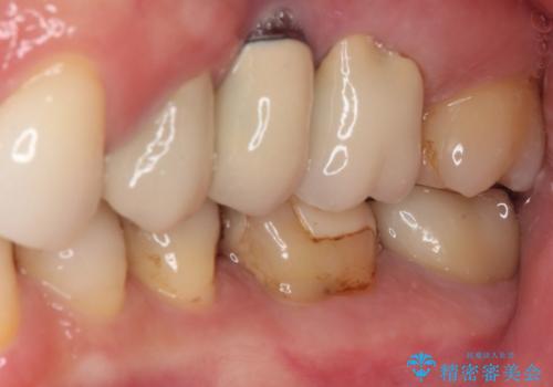 ものが挟まる　セラミッククラウンによる補綴治療の治療後