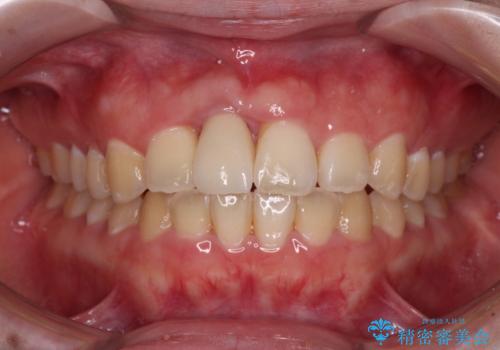 怪我をして不格好な前歯 矯正治療とインプラント補綴治療の治療後