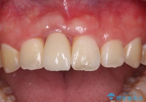 前歯インプラントの症例 治療後
