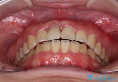 怪我をして不格好な前歯 矯正治療とインプラント補綴治療の治療後