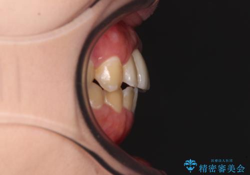 怪我をして不格好な前歯 矯正治療とインプラント補綴治療の治療後