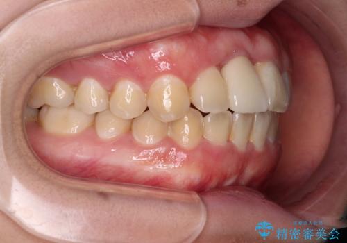 怪我をして不格好な前歯 矯正治療とインプラント補綴治療の治療後
