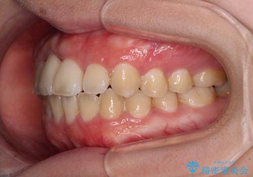 怪我をして不格好な前歯 矯正治療とインプラント補綴治療の治療後