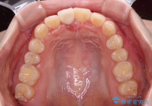 怪我をして不格好な前歯 矯正治療とインプラント補綴治療の治療後