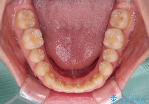 怪我をして不格好な前歯 矯正治療とインプラント補綴治療の治療後