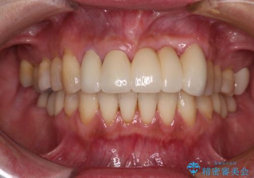 歯周病治療の症例 治療後
