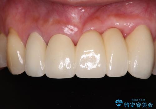 気になる所を一気に治療 総合歯科治療の治療後