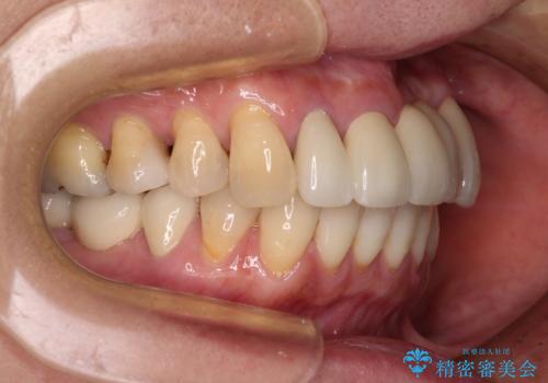 気になる所を一気に治療 総合歯科治療の治療後