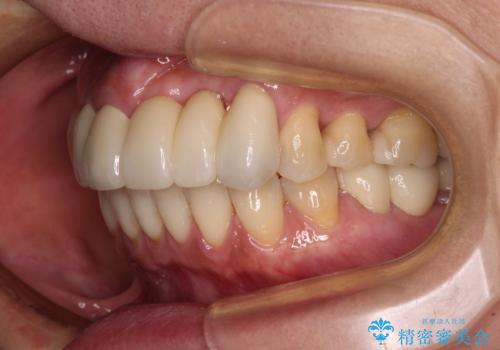 気になる所を一気に治療 総合歯科治療の治療後