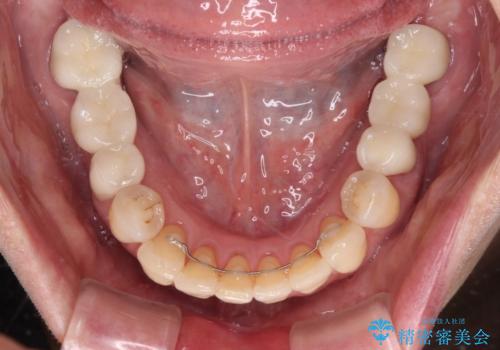 気になる所を一気に治療 総合歯科治療の治療後
