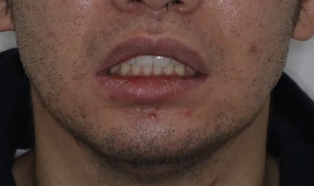 インビザライン・ライトで”すきっ歯と出っ歯”を改善の治療後（顔貌）