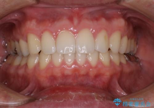 インビザライン・ライトで”すきっ歯と出っ歯”を改善の症例 治療後