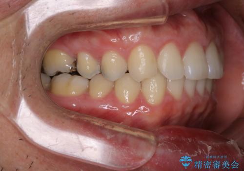 インビザライン・ライトで”すきっ歯と出っ歯”を改善の治療後