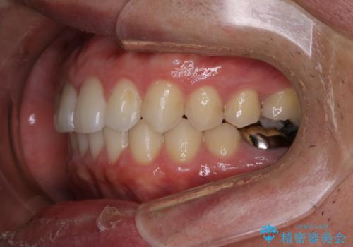 インビザライン・ライトで”すきっ歯と出っ歯”を改善の治療後