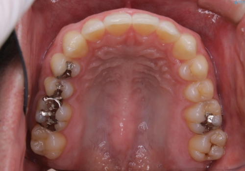 インビザライン・ライトで”すきっ歯と出っ歯”を改善の治療後