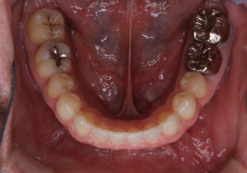 インビザライン・ライトで”すきっ歯と出っ歯”を改善の治療後