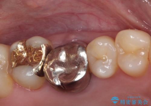 穴の空いてしまった奥歯　ゴールドインレーによるむし歯治療の症例 治療後