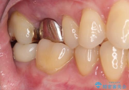 穴の空いてしまった奥歯　ゴールドインレーによるむし歯治療の治療後