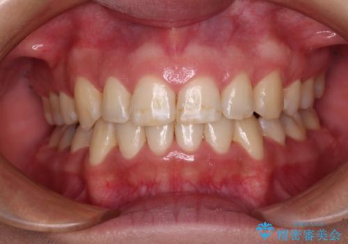 前歯のデコボコを短期間で解消　ワイヤー装置による抜歯矯正の症例 治療後