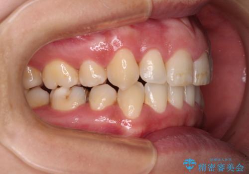 前歯のデコボコを短期間で解消　ワイヤー装置による抜歯矯正の治療後
