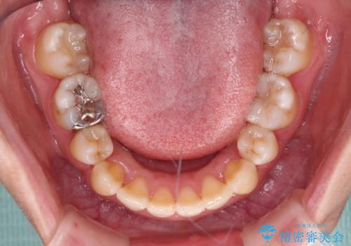前歯のデコボコを短期間で解消　ワイヤー装置による抜歯矯正の治療後