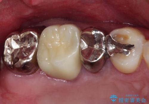 放置して悪化してしまったむし歯を早めに対応 セラミッククラウンによるむし歯治療の症例 治療後