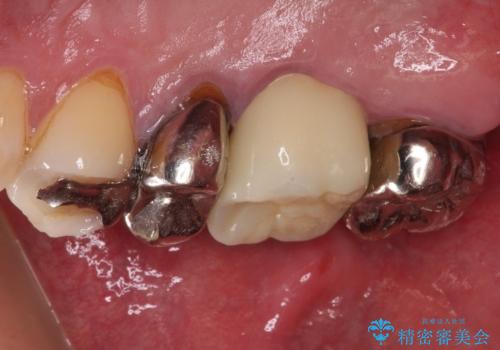 放置して悪化してしまったむし歯を早めに対応 セラミッククラウンによるむし歯治療の治療後