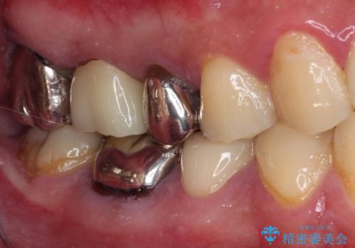 放置して悪化してしまったむし歯を早めに対応 セラミッククラウンによるむし歯治療の治療後