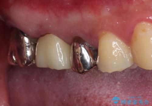 放置して悪化してしまったむし歯を早めに対応 セラミッククラウンによるむし歯治療の治療後
