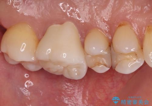 しみる奥歯 セラミッククラウンによるむし歯治療の治療後