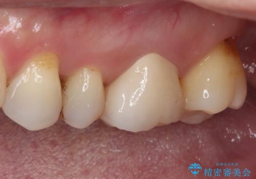しみる奥歯 セラミッククラウンによるむし歯治療の治療後