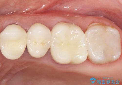 銀歯がノドに飛んできたことがトラウマ ラバーダムをして治療 50代女性の症例 治療後