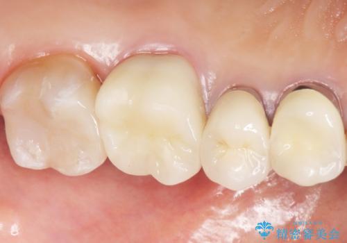 銀歯がノドに飛んできたことがトラウマ ラバーダムをして治療 50代女性の治療後