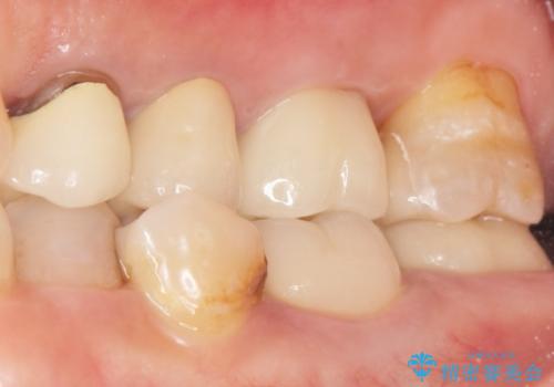 銀歯がノドに飛んできたことがトラウマ ラバーダムをして治療 50代女性の治療後