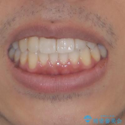 値段を抑えて歯列を整える　インビザライン・ライトによる矯正治療の治療後（顔貌）