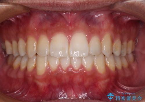 値段を抑えて歯列を整える インビザライン・ライトによる矯正治療の症例 治療後