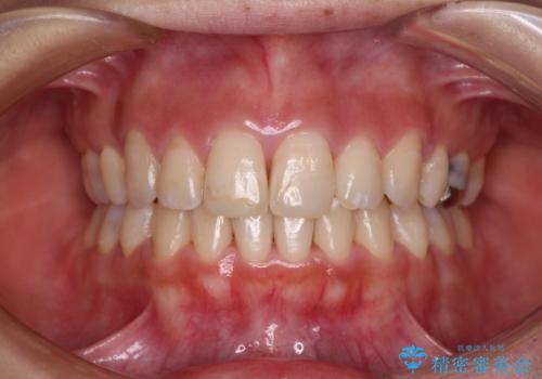突出した口元が気になる ハーフリンガル装置による抜歯矯正の症例 治療後