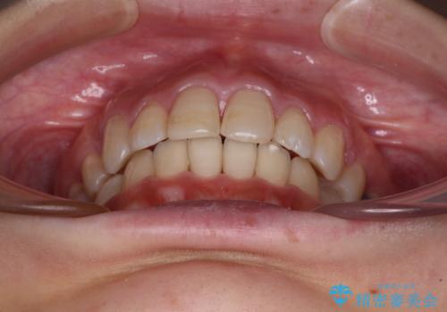 突出した口元が気になる ハーフリンガル装置による抜歯矯正の治療後