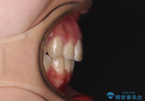 突出した口元が気になる ハーフリンガル装置による抜歯矯正の治療後